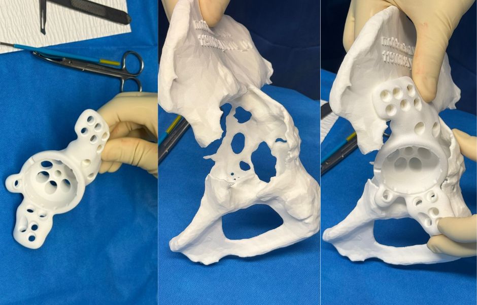 Modelo 3D de implantes de cadera a medida. Modelo 3D de un implante de cadera a medida diseñado para una cirugía ortopédica compleja.