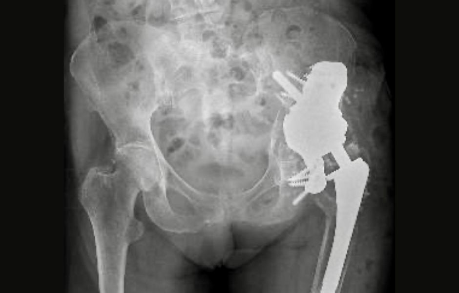 Resultado final: la radiografía confirma la correcta posición y fijación del implante a medida, solucionando por completo el problema del paciente. Radiografía postoperatoria que muestra el implante de cadera a medida perfectamente ajustado en el fémur del paciente.