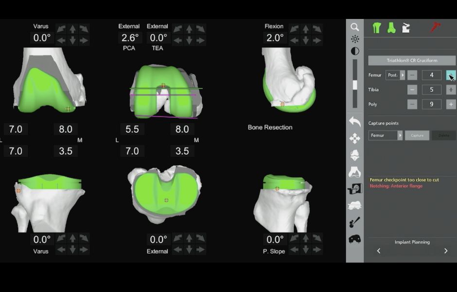 Planificación con modelo 3D en cirugía robótica Modelo 3D para cirugía robótica de rodilla