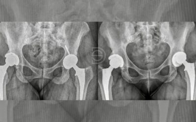 Rotura prematura del inserto de polietileno de una prótesis de cadera: caso clínico