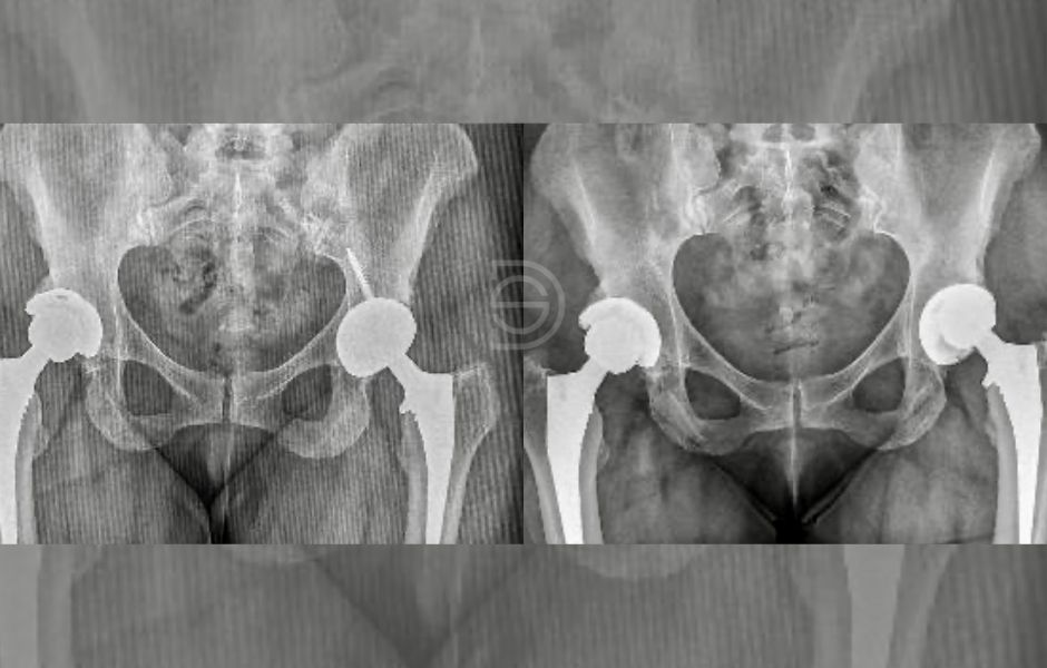 Rotura prematura del inserto de polietileno de una prótesis de cadera: caso clínico