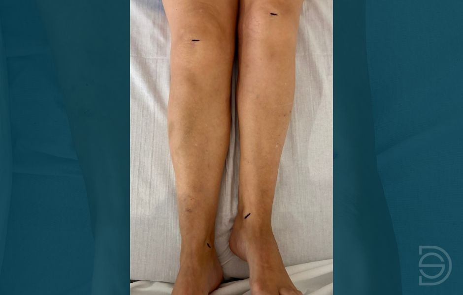 Dismetría antes de la cirugía de cadera Diferencia de longitud entre las piernas antes de la cirugía reconstructiva de cadera