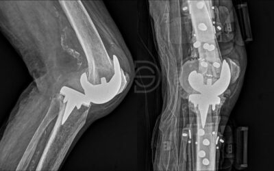 Luxación de prótesis de rodilla: un caso de inestabilidad extrema