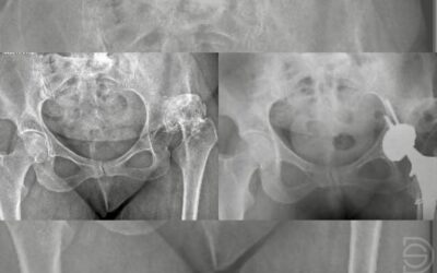 Prótesis de cadera con acortamiento femoral por displasia severa: caso clínico
