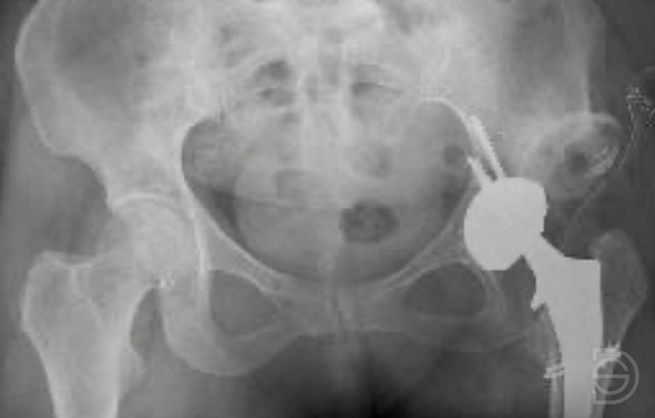 Reconstrucción de cadera con acortamiento femoral Radiografía después de una prótesis de cadera con acortamiento controlado del fémur