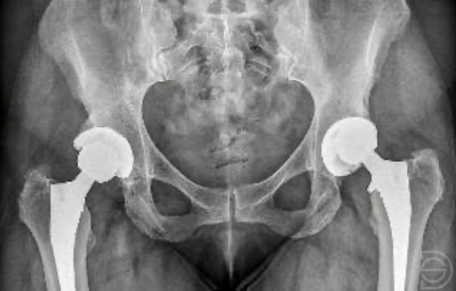 Prótesis de cadera después de la cirugía de revisión Radiografía después del recambio del componente acetabular de una prótesis de cadera
