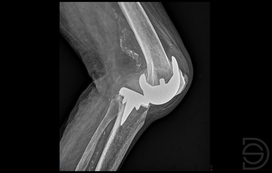 Prótesis de rodilla luxada Radiografía lateral de una prótesis de rodilla luxada