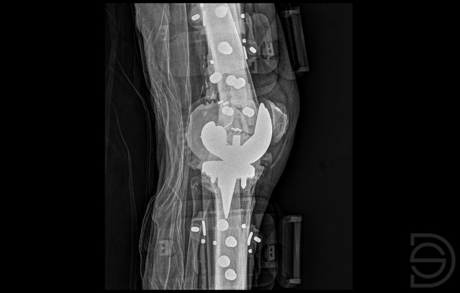 Prótesis de rodilla después de la reducción Radiografía de una prótesis de rodilla después de la reducción