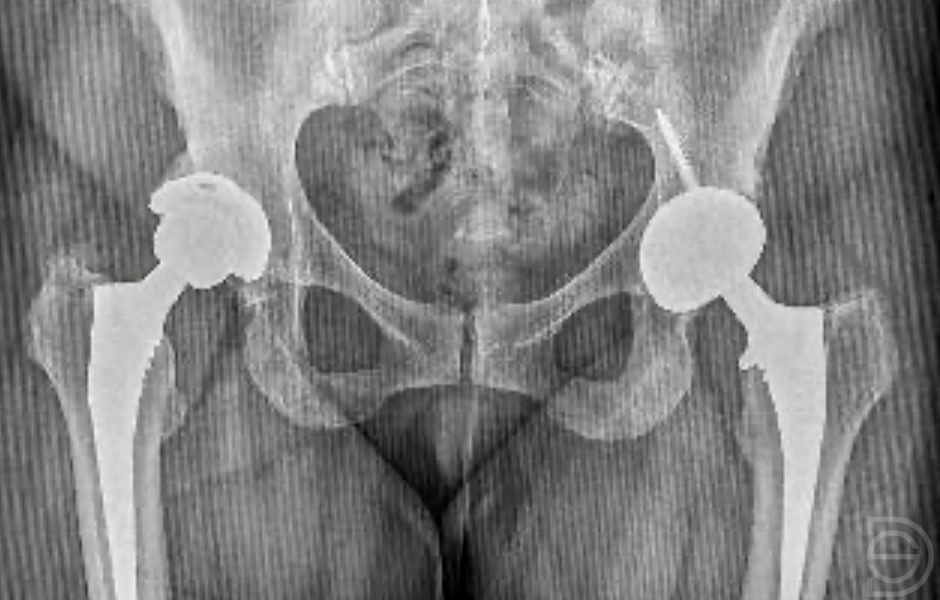 Prótesis de cadera antes de la cirugía de revisión Radiografía previa a la cirugía por rotura del inserto de una prótesis de cadera